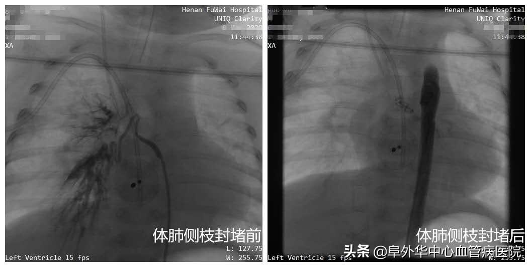宝宝支气管肺炎快好了又突然加重,新生儿肺炎久治不愈