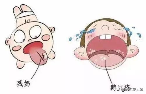 宝宝嘴巴鹅口疮反复舌苔颜色很深,初期鹅口疮上颚症状