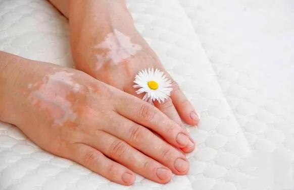 突然间长白癜风怎么回事,身上出现小白点医生说是白癜风