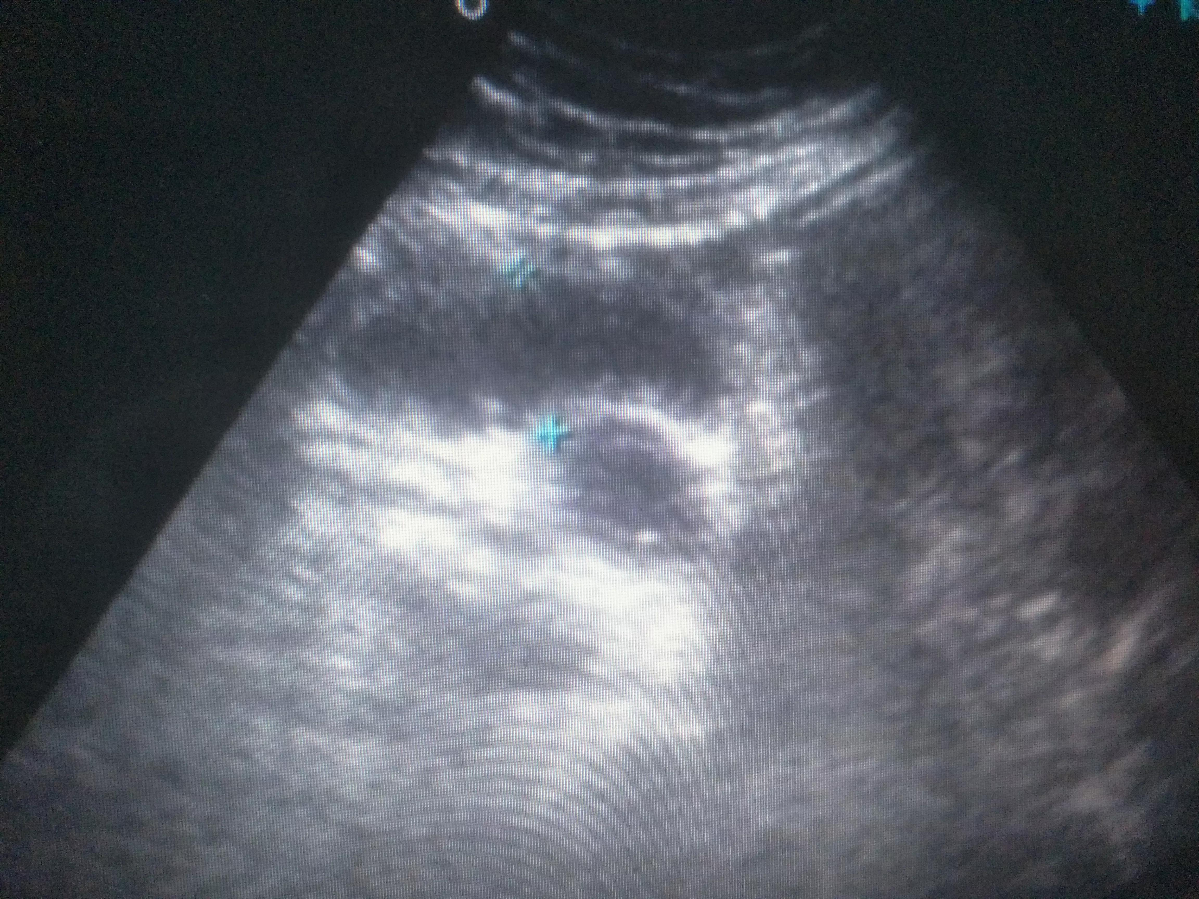 右腹部疼痛是尿道结石吗,右下腹疼痛是什么结石