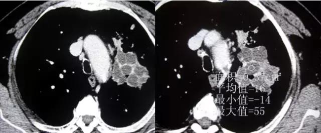 肺部ct十大征象,肺部ct正常图和异常图的区别