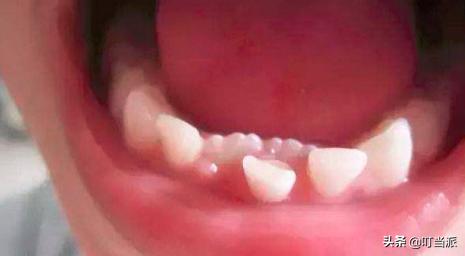 小孩长了2排牙齿有什么危害,孩子长双层牙怎么办