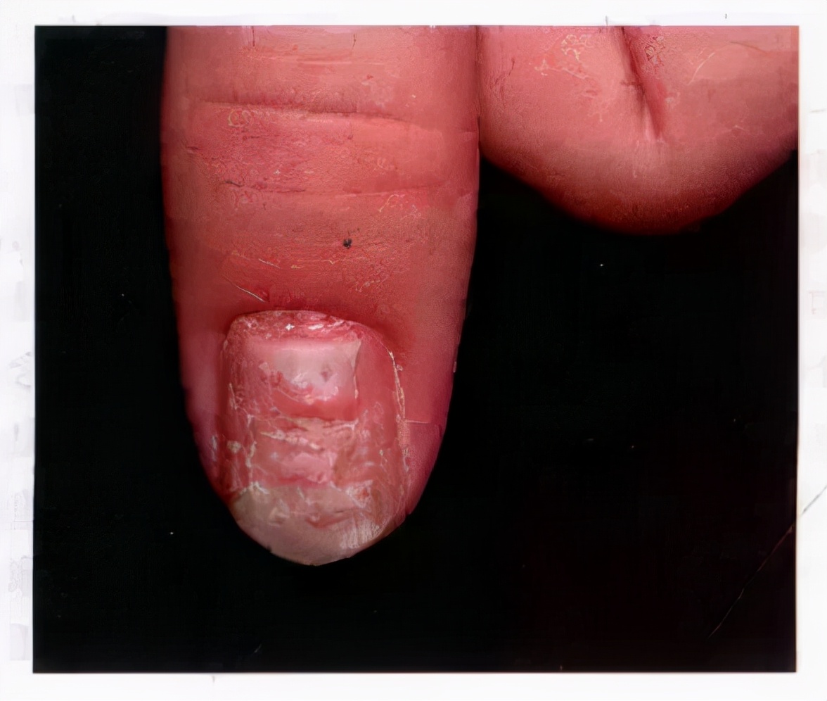 右脚大拇指甲变厚变黄竖纹啥意思,涨知识现象