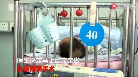 新生儿罕见现象,新生儿天生头皮缺失