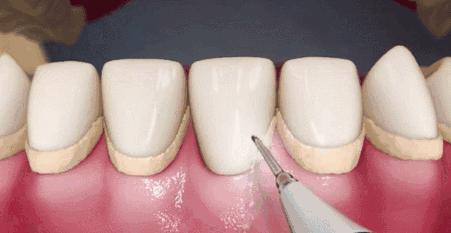 洗牙后牙齿变敏感怎么办,洗牙两周牙齿出血敏感