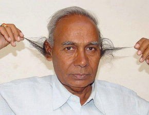 米诺地尔有什么副作用吗,米诺地尔副作用和禁忌