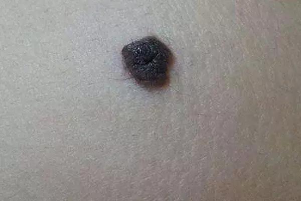出现痣警惕肝脏病变,肝痣是肝脏发出的求救信号