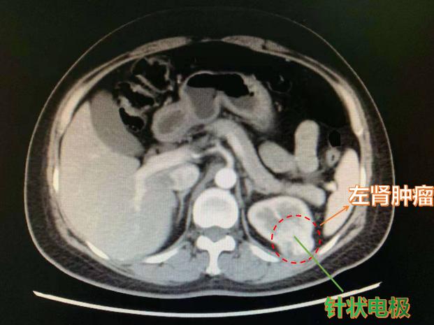 肾癌的死亡原因,肾癌的死亡症状