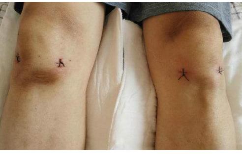 膝关节疼痛有半月板损伤能治好吗,膝盖疼半月板损伤肿胀怎么办