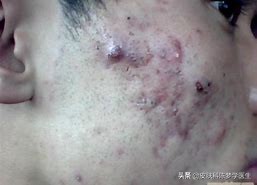 青春痘治疗最佳中成药,青春痘最好的治疗方案