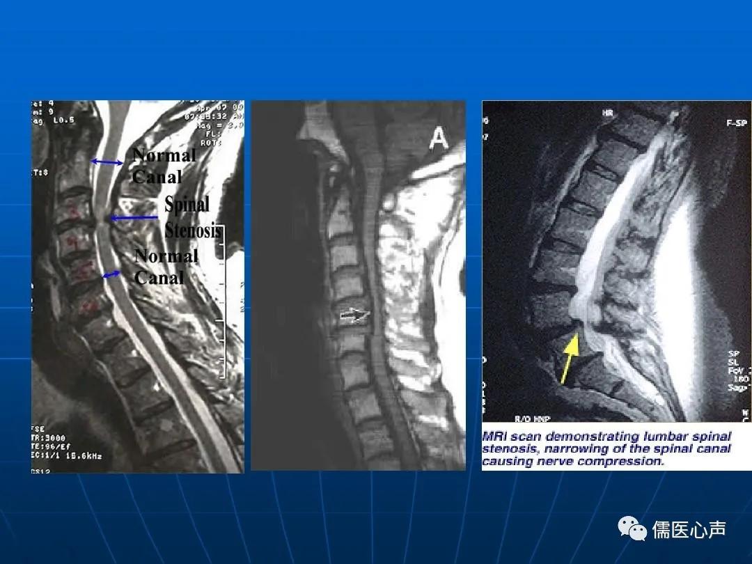 腰痛连带腰椎管狭窄怎么治,腰痛椎管狭窄怎么治疗
