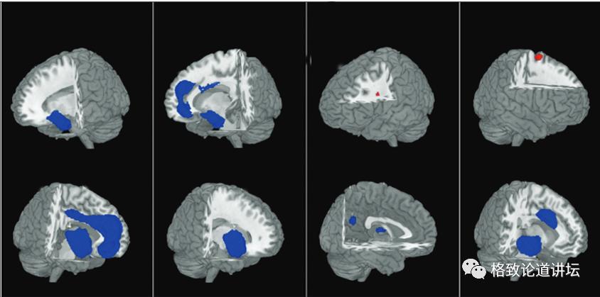 躁郁症心情转变原因,躁郁症的五大征兆和四大对策