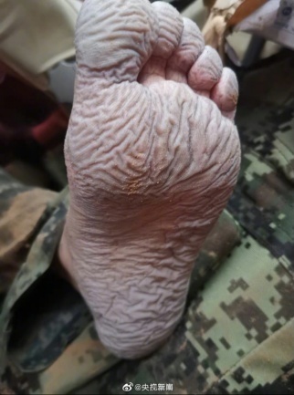 泡水过后，感觉身体被“污染”？洪灾中应该这样治愈皮肤