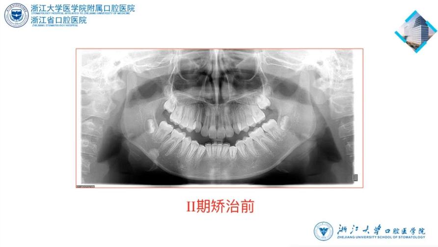 儿童9岁下颌后缩矫治,高角下颌后缩怎么矫治