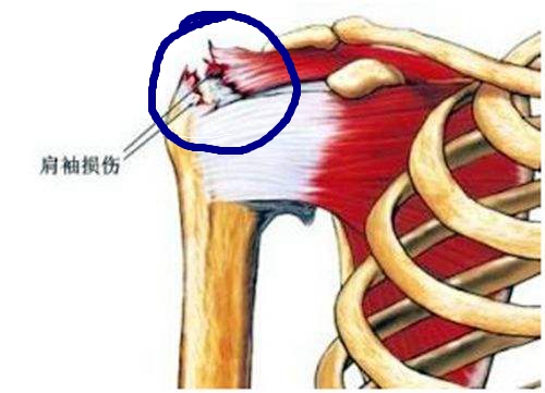 肩袖损伤手术后多长时间完全恢复,肩袖损伤手术后一般多久能恢复