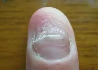 「科普」指甲型银屑病与灰指甲的区别