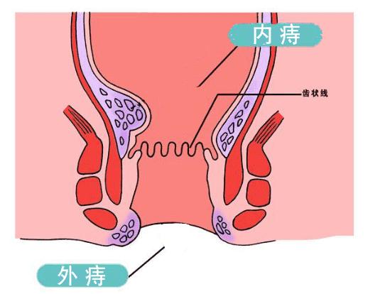 肛肠科一般怎么治疗痔疮,肛肠科指诊能确定肛肠癌吗