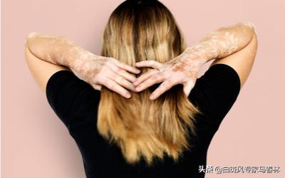 患白癜风要关注什么,患白癜风要如何治疗好呢