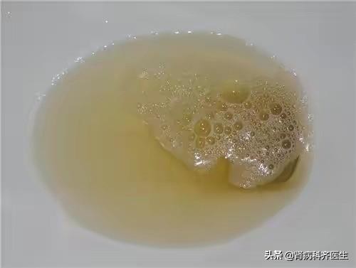 怀孕出现蛋白尿是怎么回事,孕检蛋白尿是怎么回事