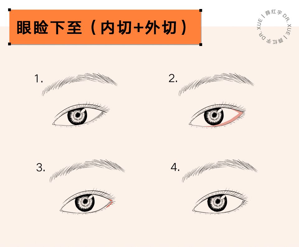 什么样的眼睛适合开外眼角,要不要做内外眼角