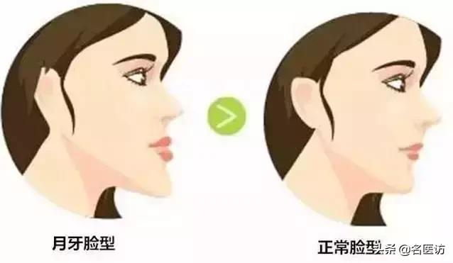 2020牙齿矫正攻略请查收,今日头条修复牙齿