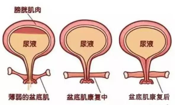 女人盆底肌修复有必要做吗,女性盆底肌修复是用什么