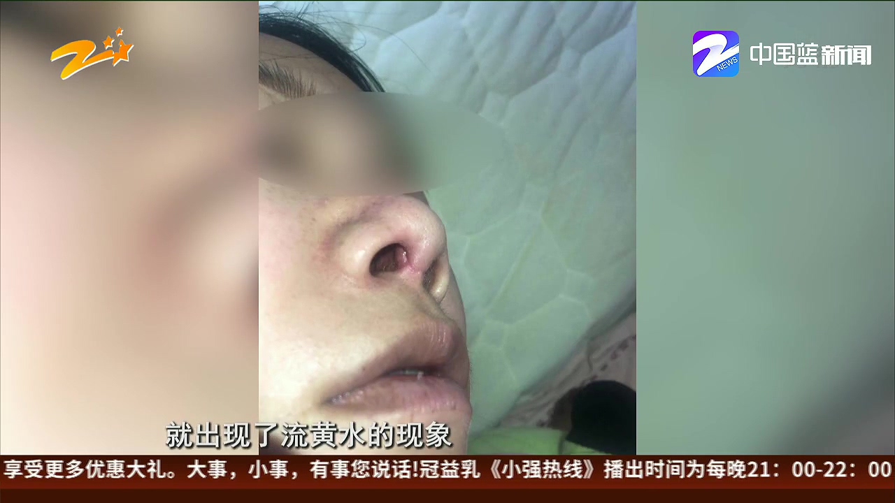 女子做鼻综合手术，莫名其妙鼻子流出黄色液体，这事到底怪医院还是怪她？
