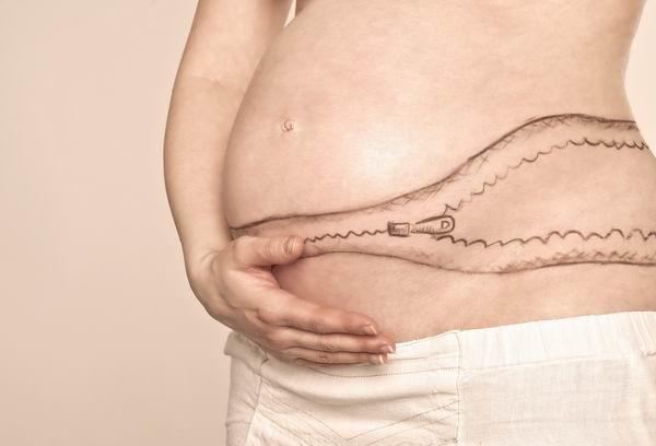 剖腹产的疤痕跟什么疤痕像,女人剖腹产疤痕十年后还有疤痕吗