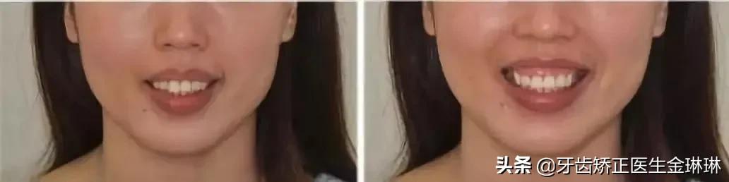 露龈笑对颜值有多大影响,颜值杀露龈笑