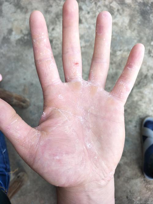 手脱皮是什么原因该怎么办,手脱皮是什么原因造成的怎么治疗