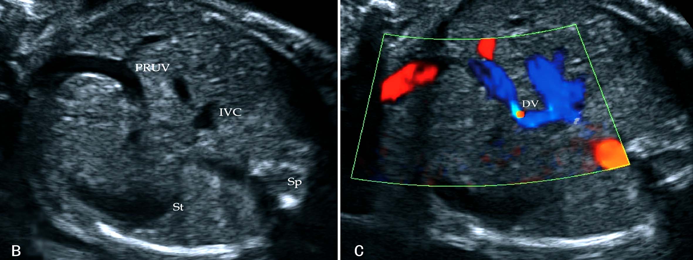 做彩超可以看出来脐带多长吗,超声检查脐带绕颈一圈正常吗