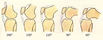 髌骨软化髌上囊积液怎么治疗,髌骨软化导致膝盖炎症