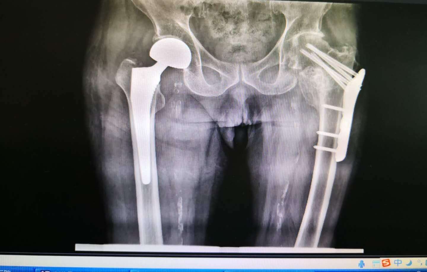 脑血栓遭罪的视频,家有病人要关注什么