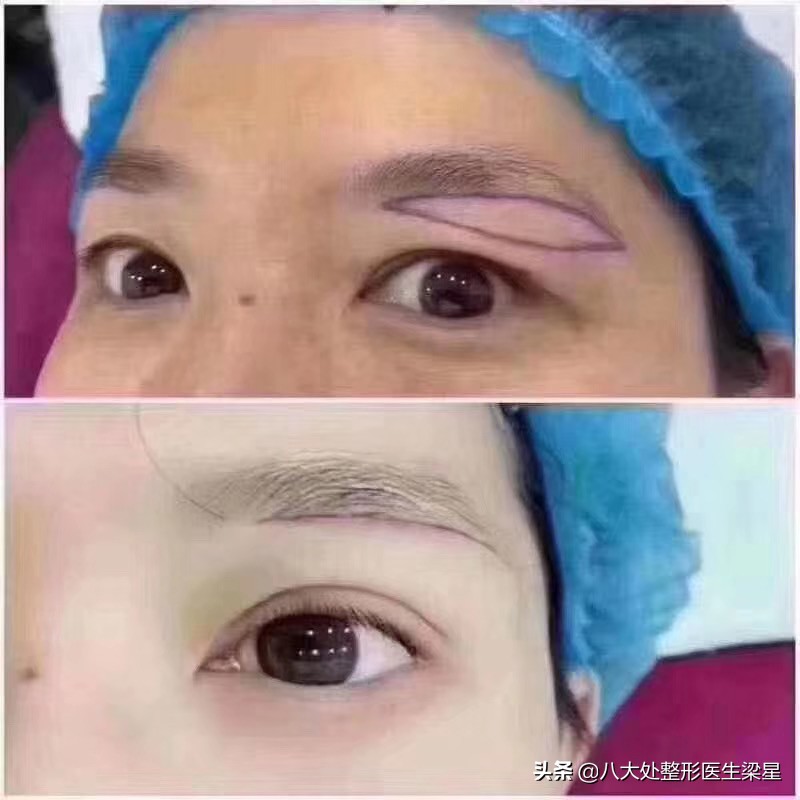 抬头纹真的与上睑下垂有关吗,睁大眼睛就有抬头纹怎么办