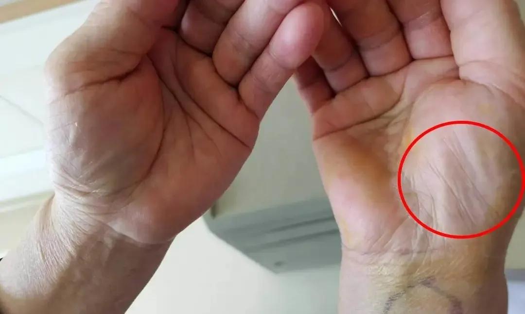 手部出现三种现象,手部发麻是大病先兆