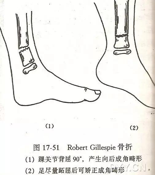 所有骨折都叫什么名字,骨折的名称有哪些