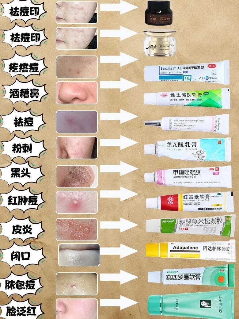 油痘肌祛痘药膏医生推荐,祛痘印痘坑护肤推荐