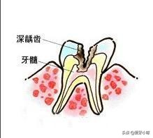牙齿缺了一小块疼痛怎么办,牙齿缺了一块很疼怎么补救