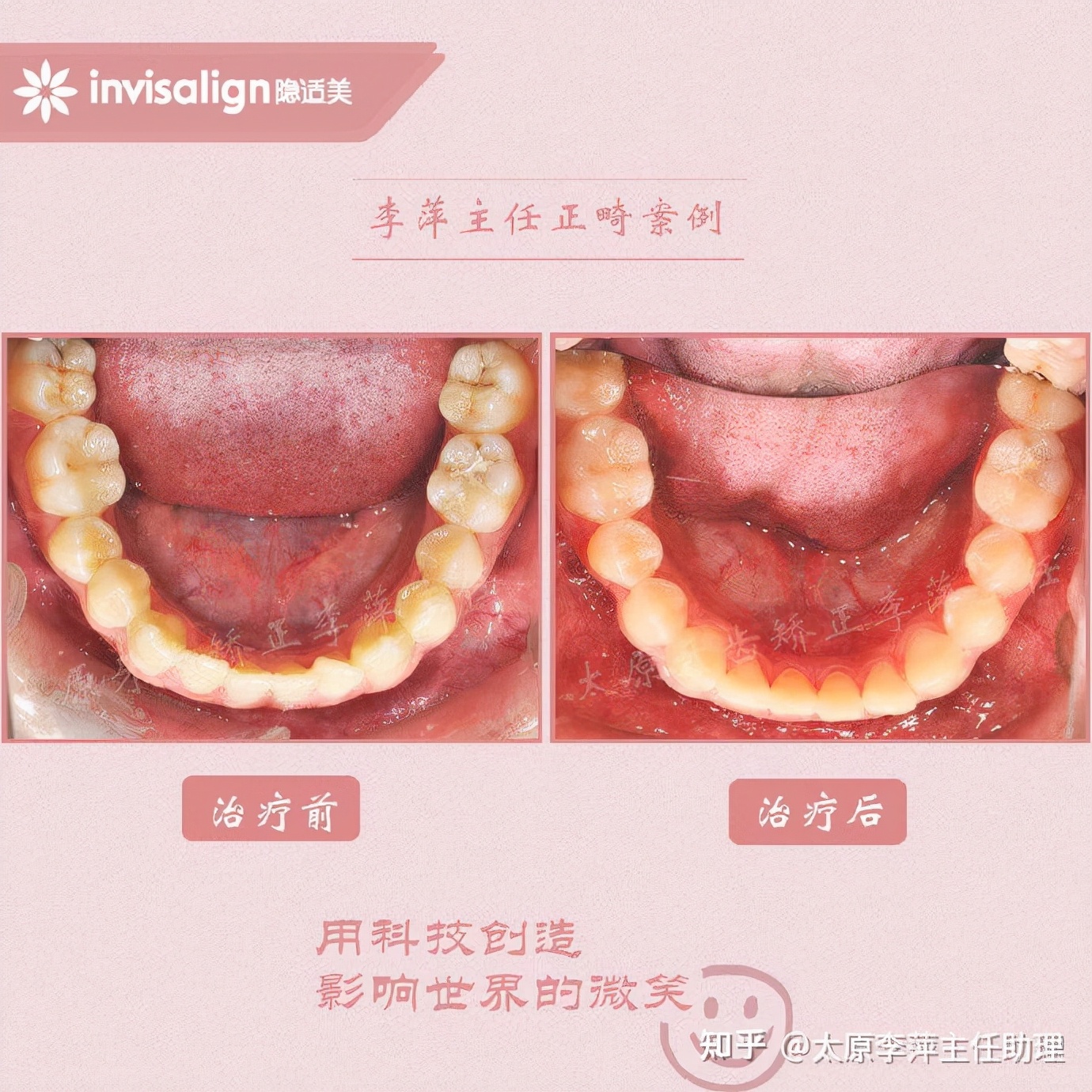太原牙齿矫正靠谱吗,太原成人隐形牙套牙齿不齐