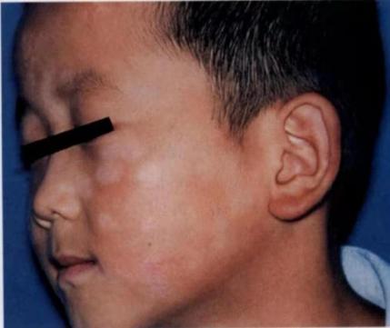 白斑是白癜风还是糠疹如何鉴别呢,宝宝脸上有白斑是脾胃虚吗