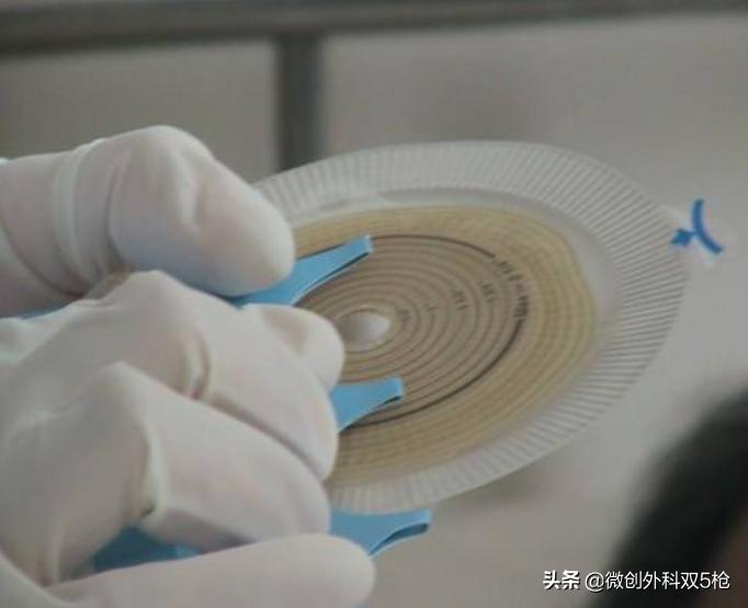 直肠癌永久性结肠造口标准,没有造口如何预防肠漏