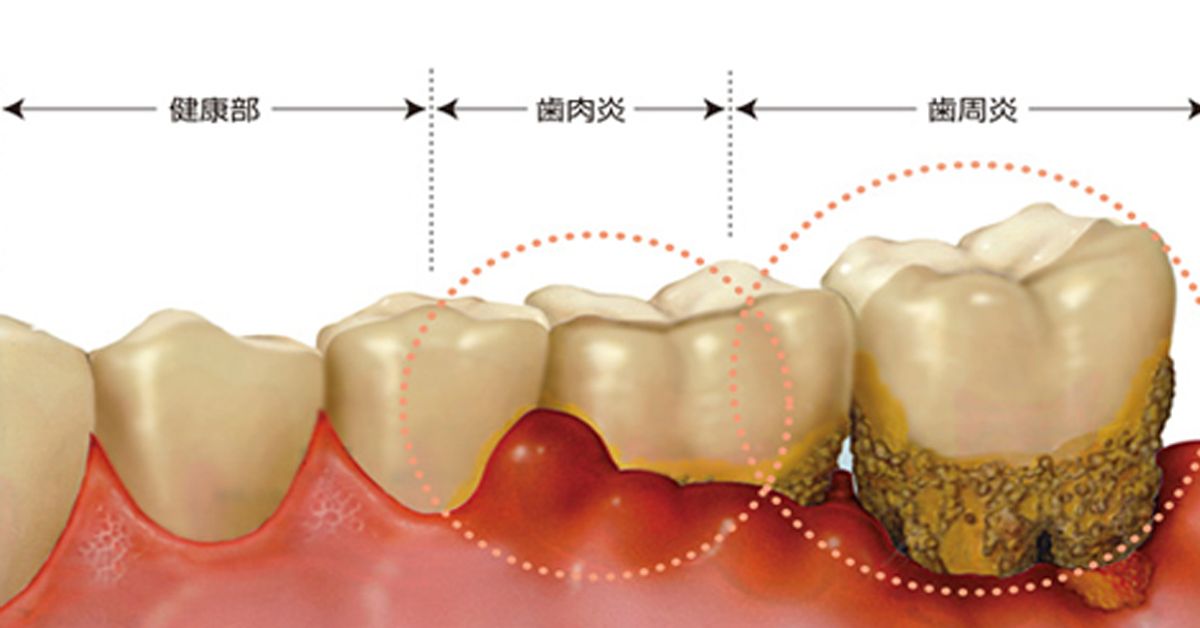 牙龈萎缩导致牙根酸痛怎么治疗,牙龈萎缩牙根腐烂怎么办