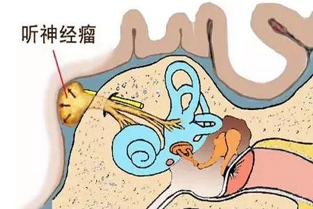 中药治疗听神经瘤的成功案例,听神经瘤手术残留的最好治疗方案