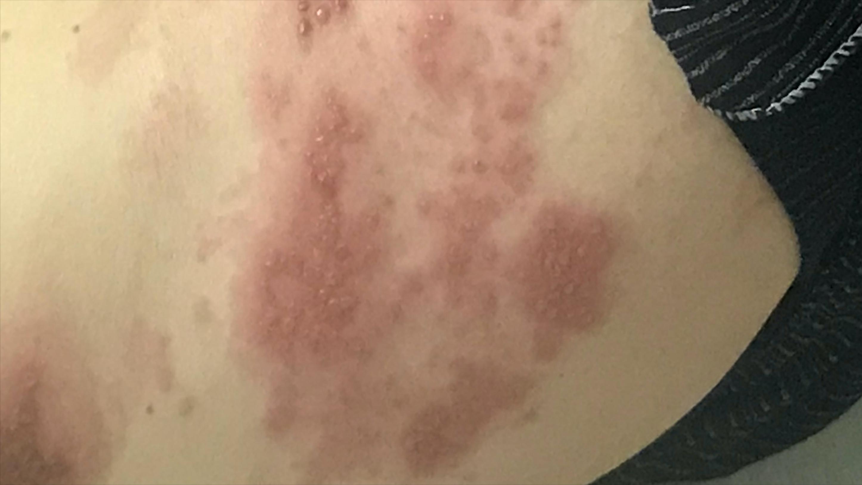 如何区分中药过敏还是带状疱疹 (过敏刚好又起了带状疱疹)