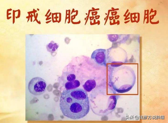 胃印戒细胞癌做手术后还会复发么,胃印戒细胞癌早期没化疗可以吗