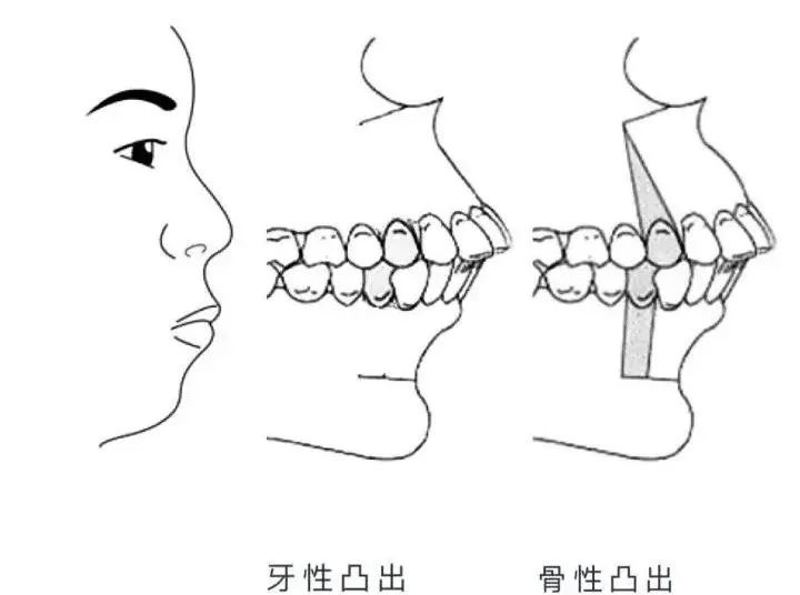 嘴凸的女生其实也很好看,凸嘴女生怎么微笑好看
