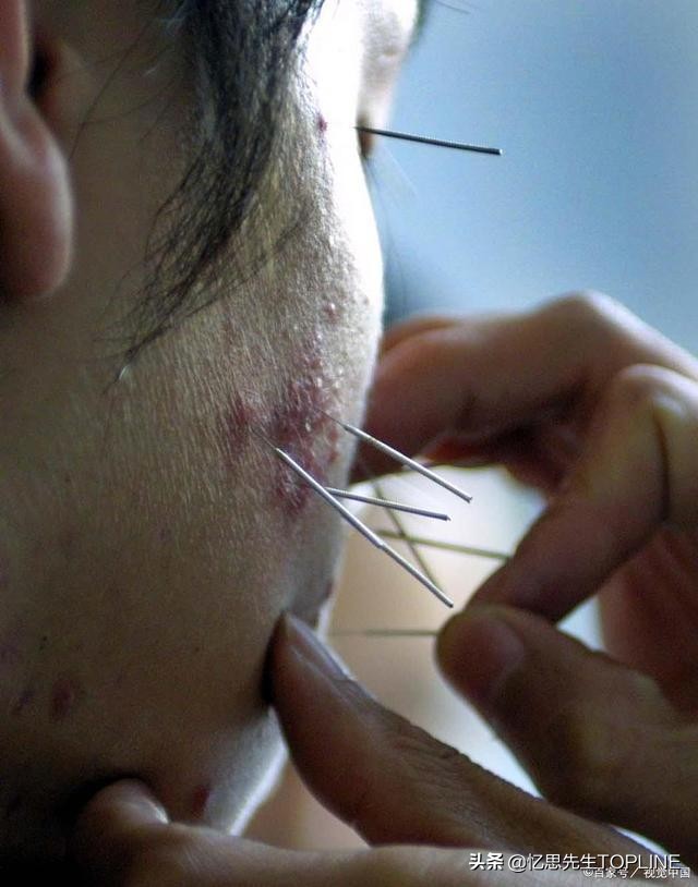 脸上总是长痘痘，而且长期反复，怎么办？试一下这几个方法