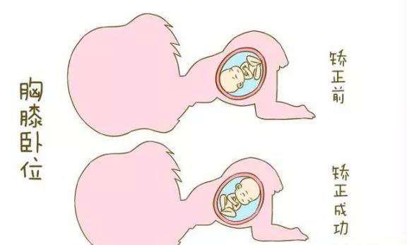 臀位有多大概率可以顺产,臀位能顺产的几率