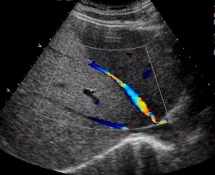 脂肪肝的防治与调养,脂肪肝的防治食物