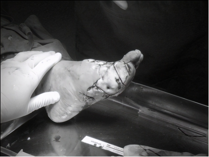 糖尿病脚趾溃烂病程进展,糖尿病脚趾溃烂长肉芽了多久好